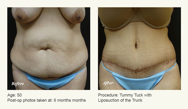 Tummy Tuck In Austin Texas